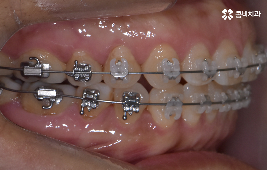 중년치아교정 이제라도 해도 될까요 관련 이미지 13