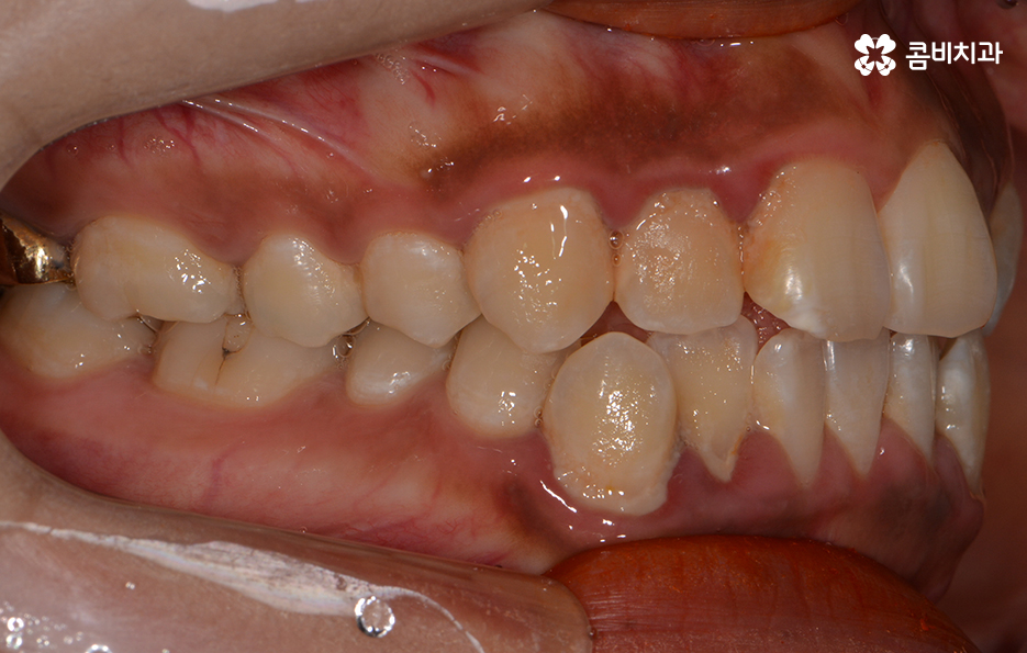 클리피씨교정 알아볼 때 꼭 신경 써야 하는 점은! 관련 이미지 2