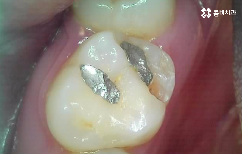 어금니 충치 깨짐 판단기준부터 세워보세요 관련 이미지 4