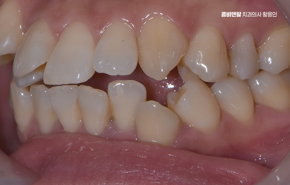 앞니 틀어짐 교정 조화롭게 마무리하려면 관련 이미지 3