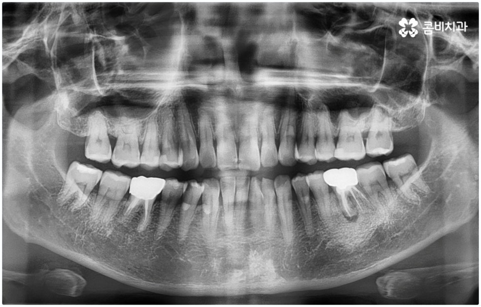 원데이임플란트 받고 싶으신가요? 관련 이미지 1