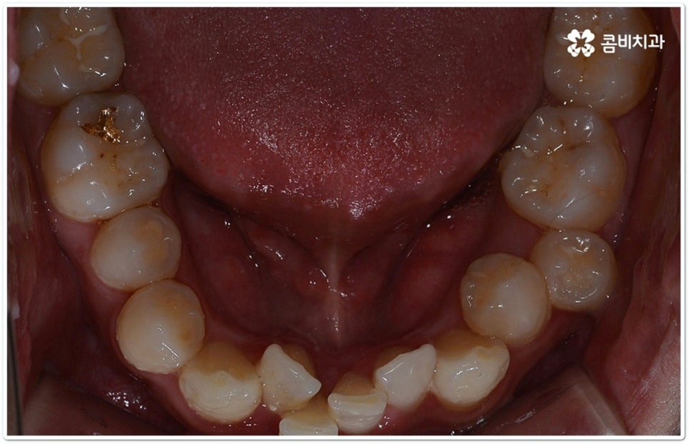 클리피씨교정 합리적인 초이스! 관련 이미지 5