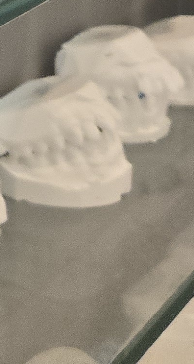 앞니 틀어짐 부분교정 얼마나 걸릴까 관련 이미지 48