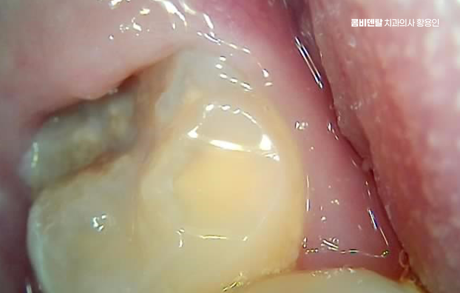 아래 사랑니 발치 통증 미리 알고 대처하려면 관련 이미지 3