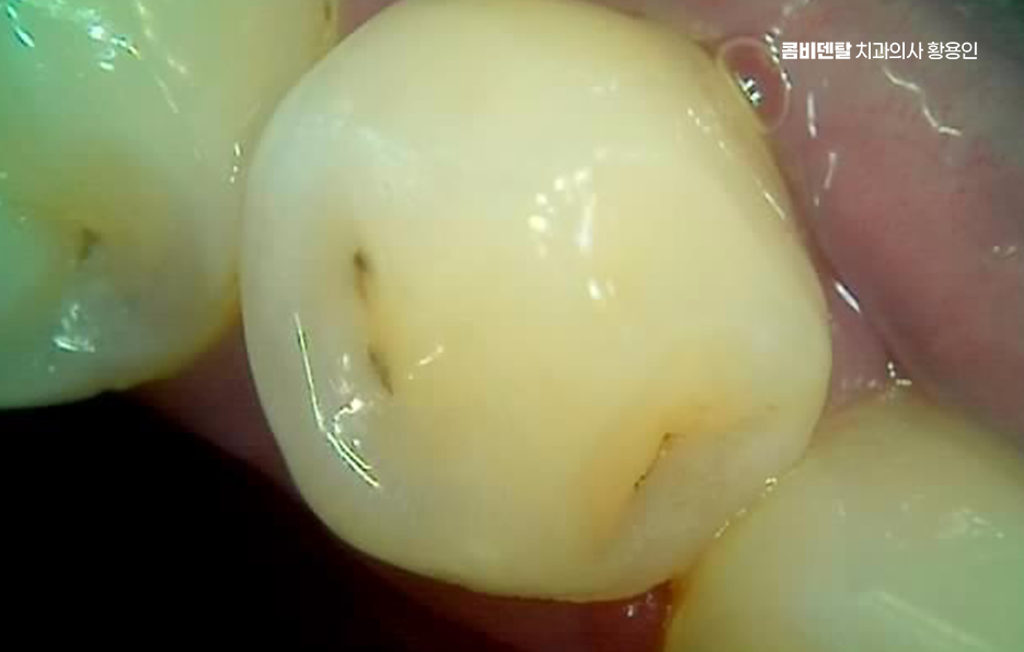 어금니 충치 단계 미리 알아차리려면 관련 이미지 8