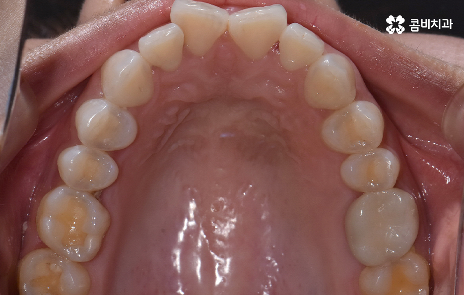 앞니 틀어짐 교정 방법 이럴때는 좀더 간단해요 관련 이미지 5
