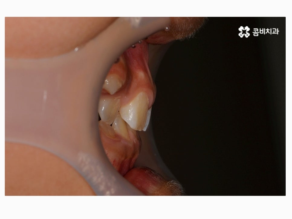 과개교합교정 어릴때 고쳐주면 좋은 사례 관련 이미지 2