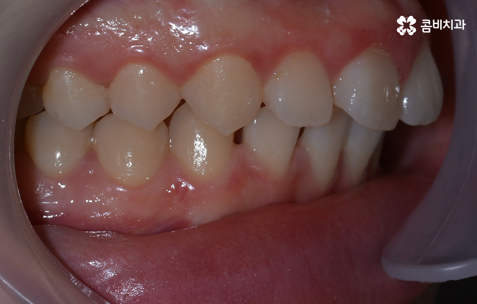 치아 벌어짐 교정으로 앞니 돌출까지 해결하기 관련 이미지 2