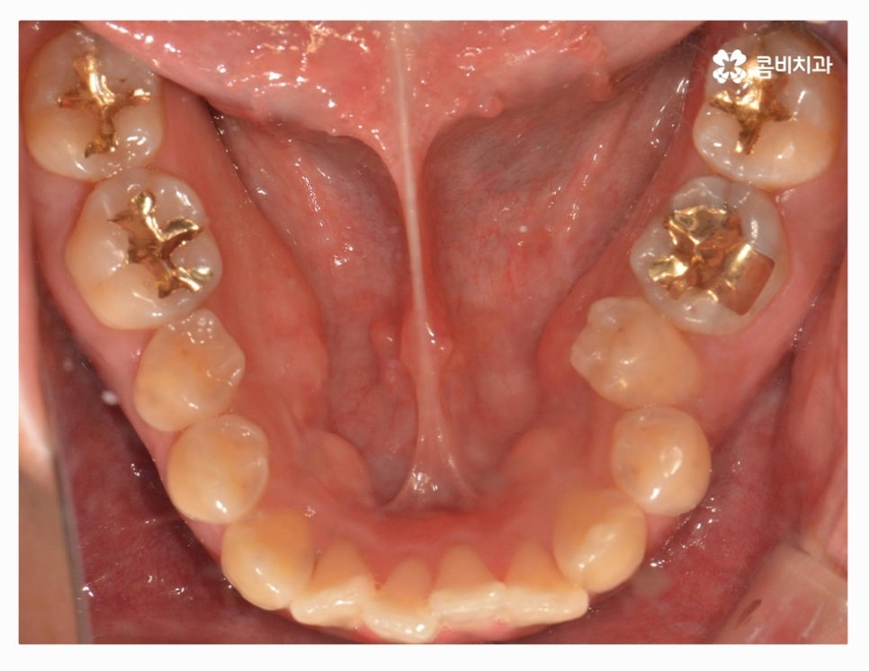 클리피씨교정 올바르게 판단하려면 관련 이미지 5