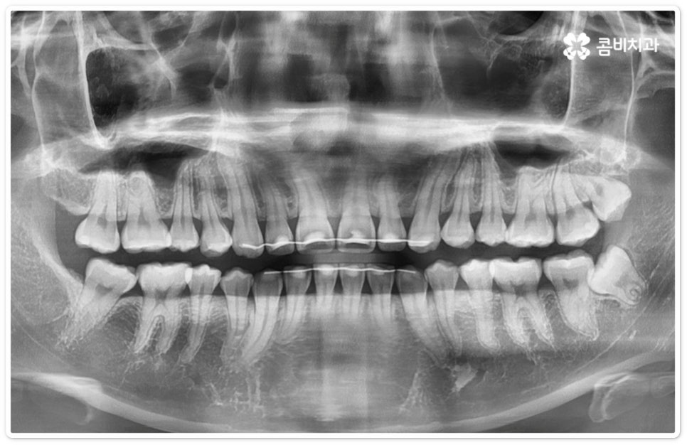 누운사랑니발치 이모저모 알아봐요 관련 이미지 1
