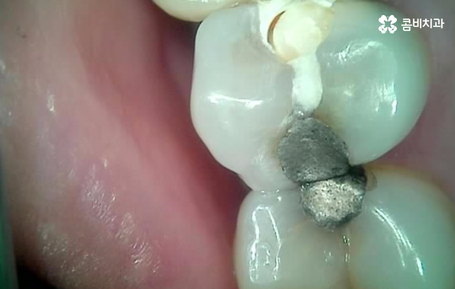 명동치과 놓치기 쉬운 2차충치에 주의하려면 관련 이미지 2