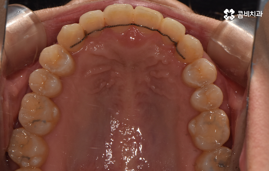 비발치치아교정 고민되는데 발치하면 안좋나요 관련 이미지 13