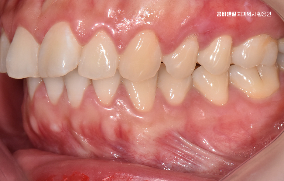 돌출입 팔자주름 교정 얼마나 바뀔까요 관련 이미지 3