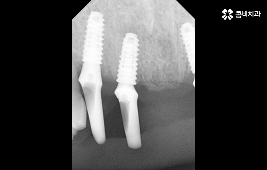 앞니임플란트 이런 조건들을 따져보세요 관련 이미지 5