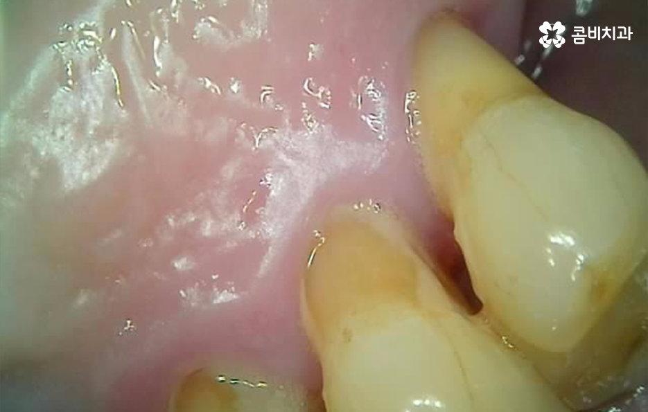 50대임플란트 각별하게 주의해야 하는 시기 관련 이미지 2