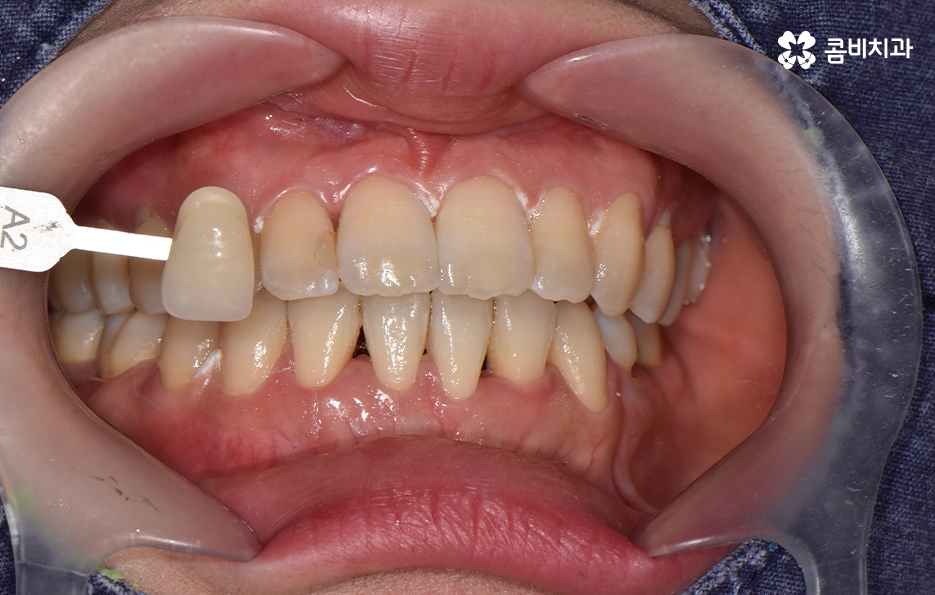 치과 치아미백 이렇게 시작해보세요 관련 이미지 4