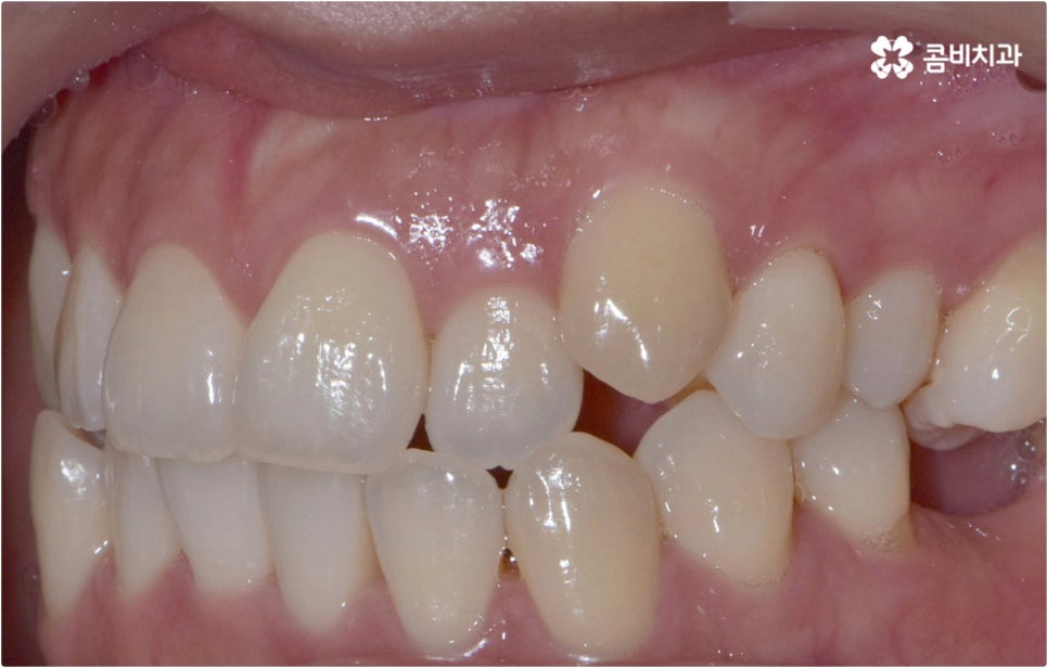 치아설측교정 보이지않아 좋아요 관련 이미지 7