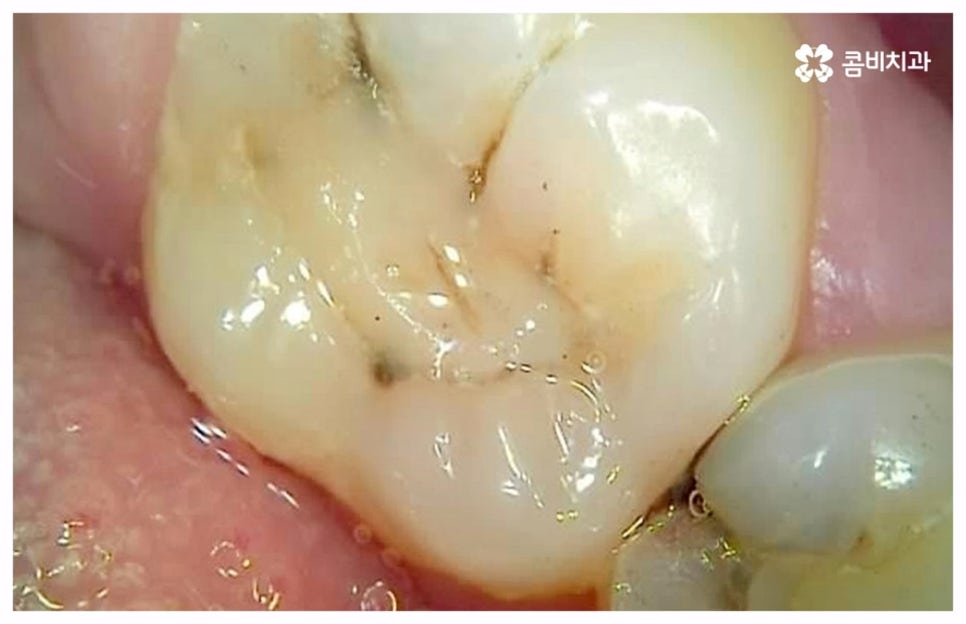 치통이 심할때 어떻게 해야하나요 관련 이미지 7