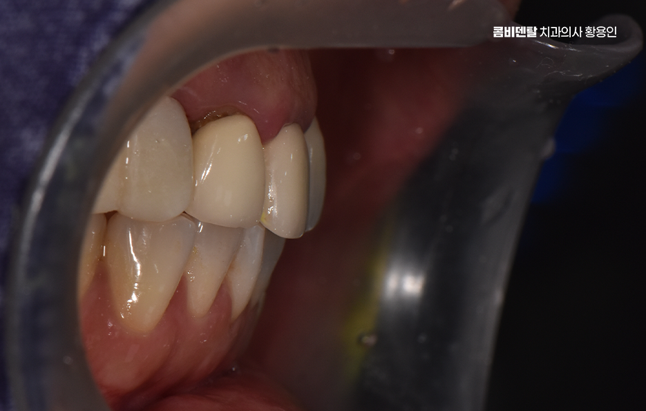 앞니 크라운 교체 깔끔하게 정리하려면 관련 이미지 2