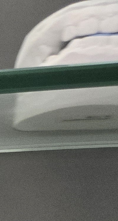 윗니 전체 임플란트 뭐부터 해야할까 관련 이미지 18