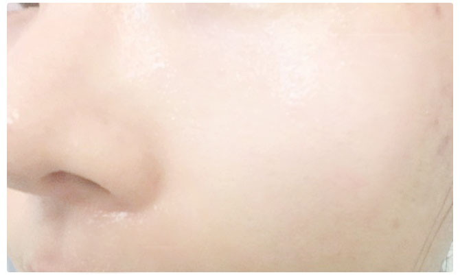 얼굴피지제거 빠르게 하는 방법! 관련 이미지 7