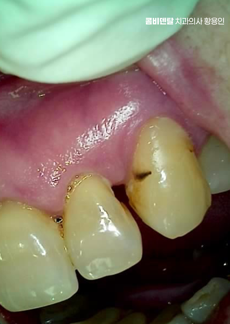 치아 사이 벌어짐 심해지는 이유부터 알아보면 관련 이미지 4