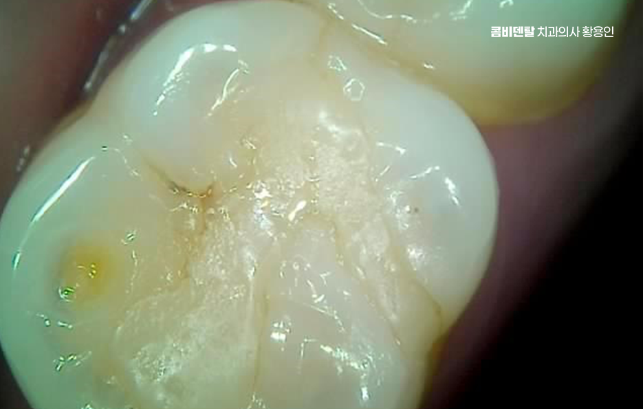 명동치과 흔하게 놓치는 사례를 정리해요 관련 이미지 3