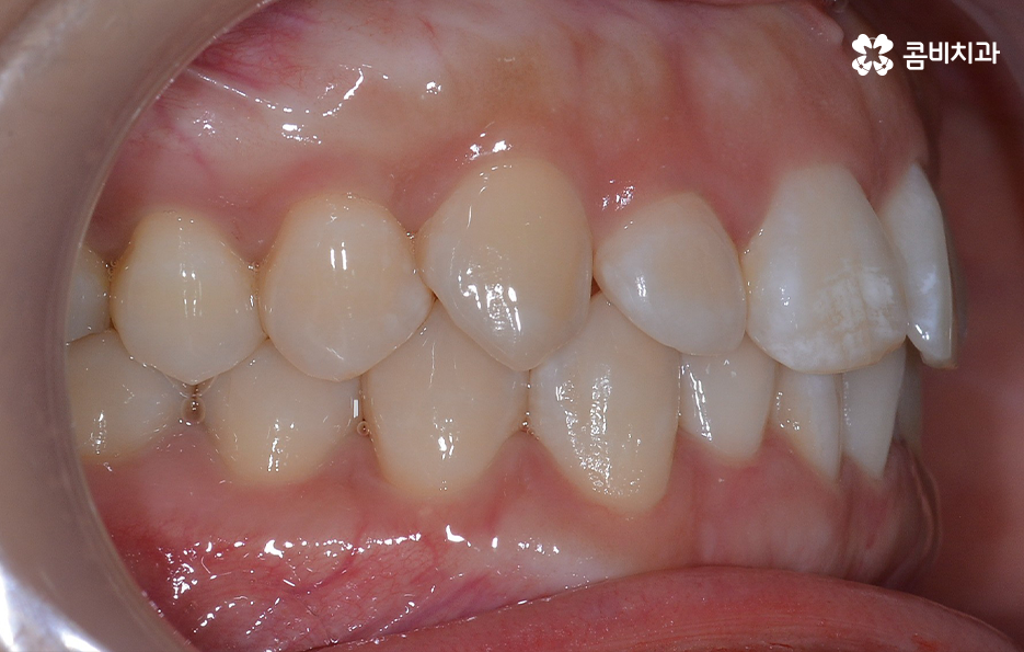 비발치치아교정 고민되는데 발치하면 안좋나요 관련 이미지 5
