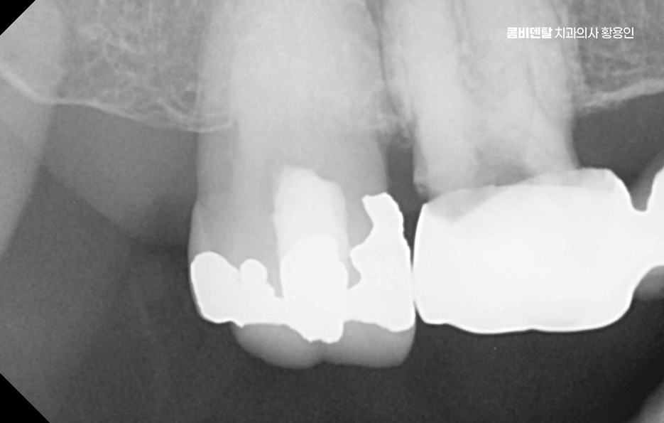 어금니 임플란트 안하면 후회하게 되는걸까 관련 이미지 2