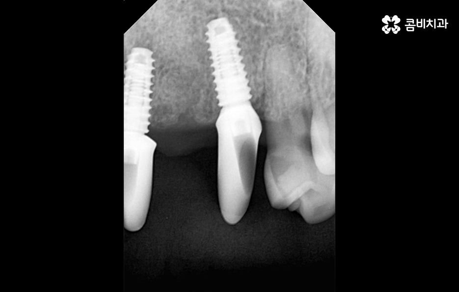 앞니임플란트 이런 조건들을 따져보세요 관련 이미지 6