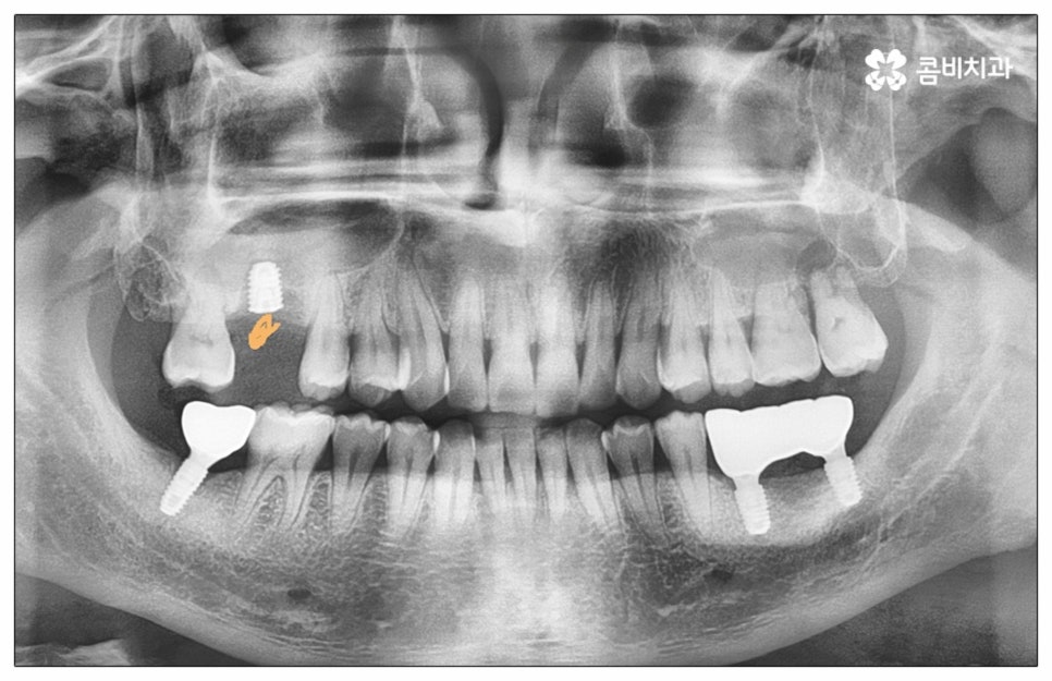 건강보험임플란트 혜택받아 보세요 관련 이미지 11