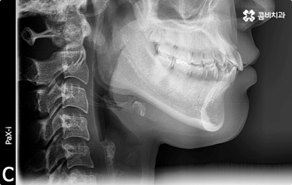 직장인치아교정 어떻게 시작하나요? 관련 이미지 1