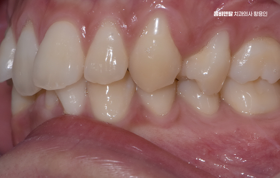 Can Crooked Lower Teeth Be Improved Without Extraction? image 4