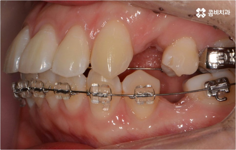 돌출입 치아교정 부모와 아이가 함께 알아봐요 관련 이미지 6