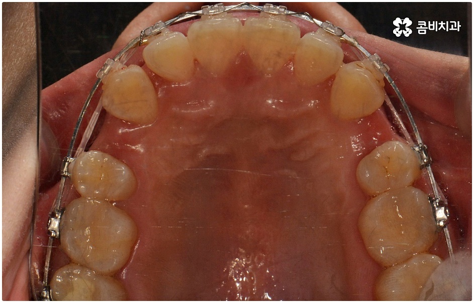 돌출치아교정 언제가 좋을까요 관련 이미지 7