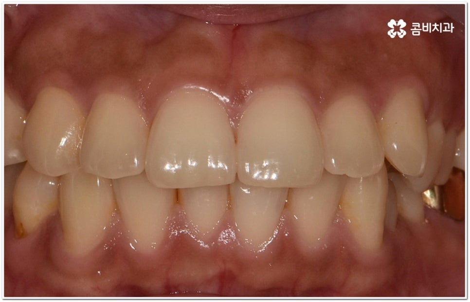 돌출입교정치과 알아보는 기준은 관련 이미지 3