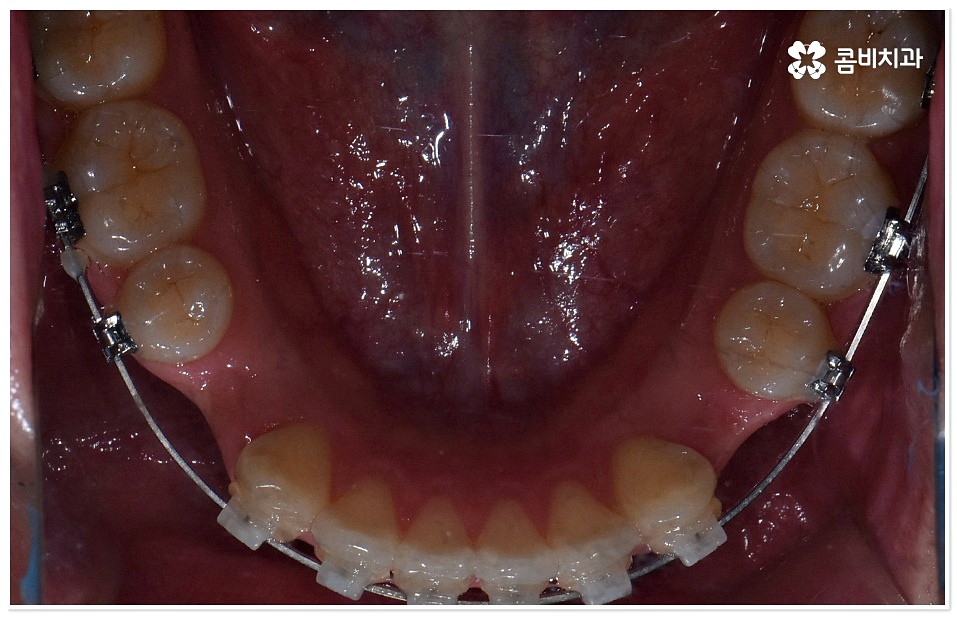 덧니치아교정 고려할 사항들은 관련 이미지 5