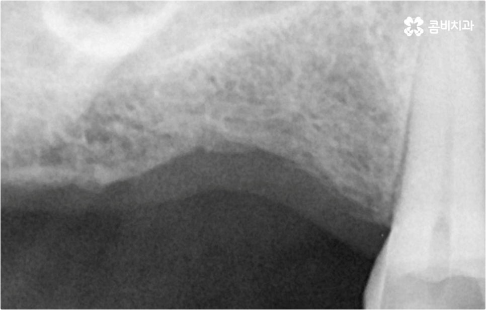 전악임플란트 고려할 사항들은 관련 이미지 2