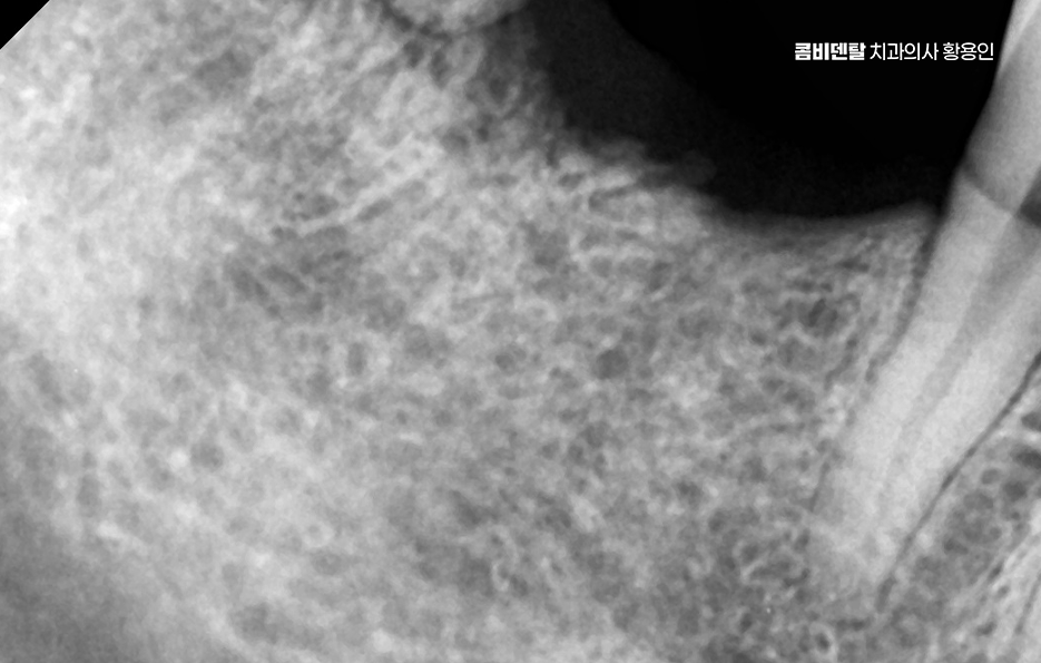 치아 발치 후 임플란트 언제부터 준비할까 관련 이미지 2