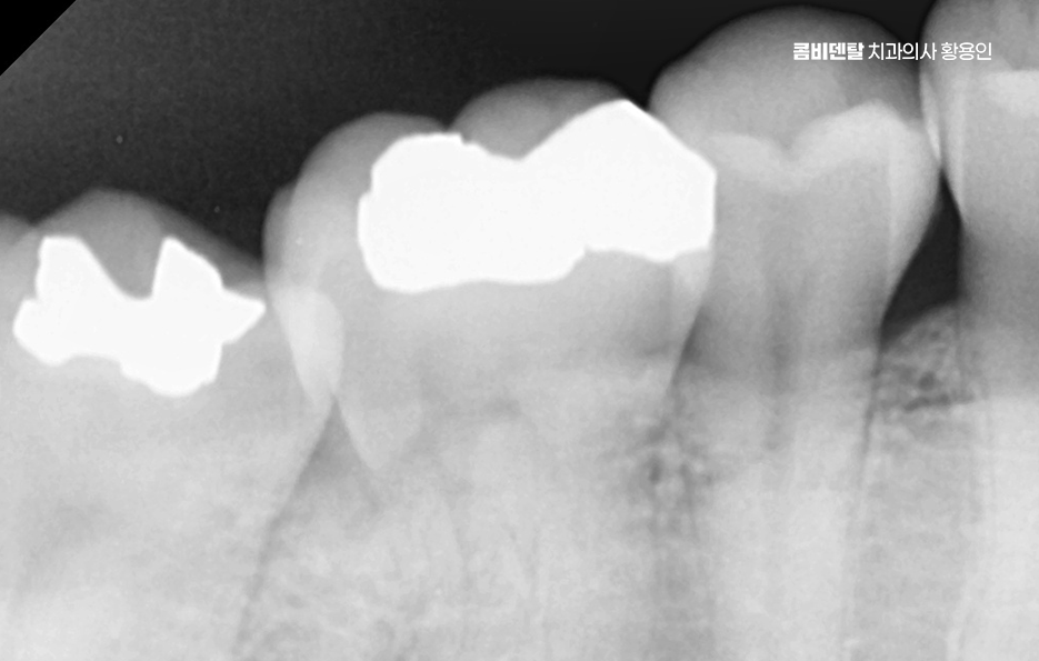 아말감 교체 레진 인레이 어떻게 대처하면 될까 관련 이미지 7