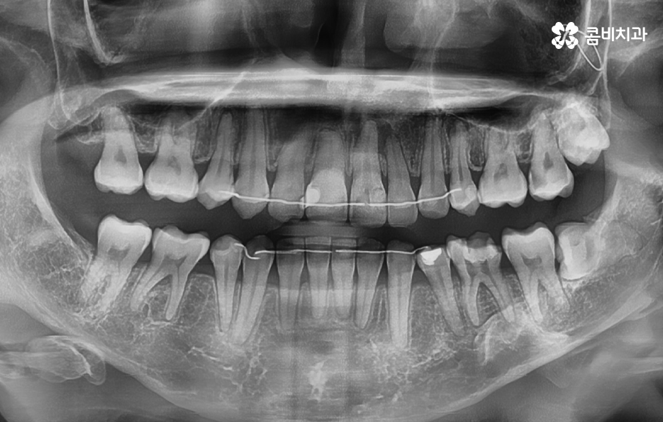 사랑니 어금니 통증 동시에 아프다면 관련 이미지 1