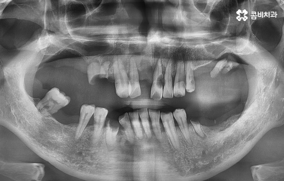 치주염 발치 이렇게나 심각하네요 관련 이미지 1
