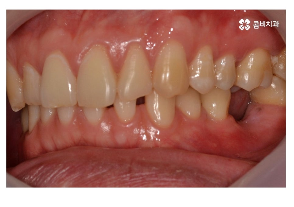 20대임플란트 잦아지는 이유를 알아본다면 관련 이미지 5