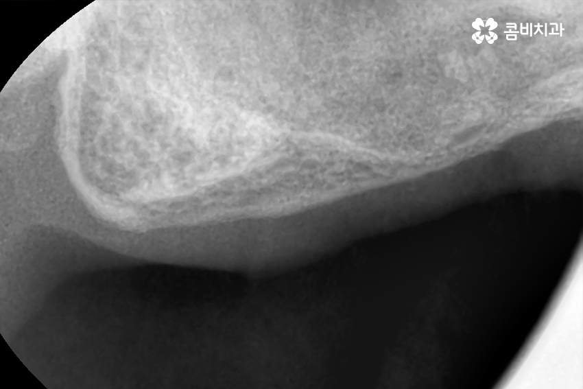 임플란트 수술 여전히 결코 간단하게 볼 수 없는 이유 관련 이미지 2