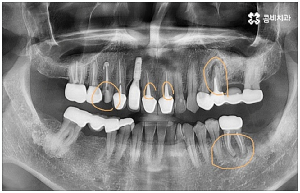 당일임플란트 나도 할수있나요 관련 이미지 3