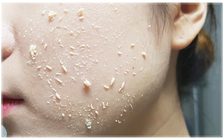 블랙헤드없애는법 더 강력하게 돌아왔다 관련 이미지 7