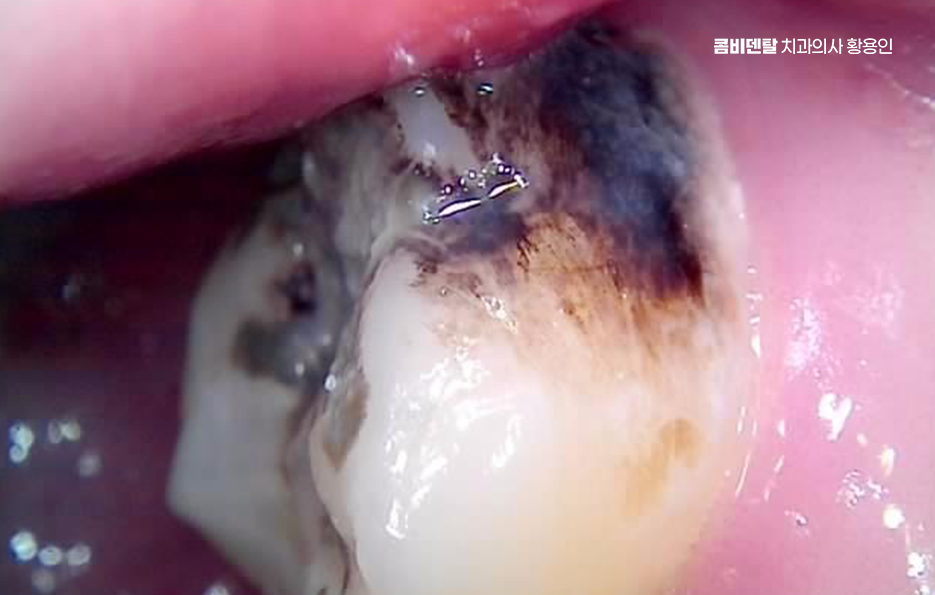 치아 시림 통증 갈수록 심해지다면 관련 이미지 7