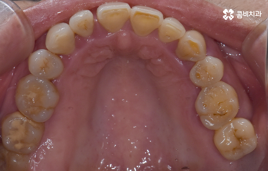 임플란트 해야 하는데 치아교정이 하고 싶다면 관련 이미지 5