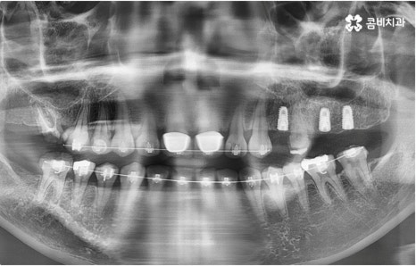 명동치과 타고난 이의 수명은 관련 이미지 8