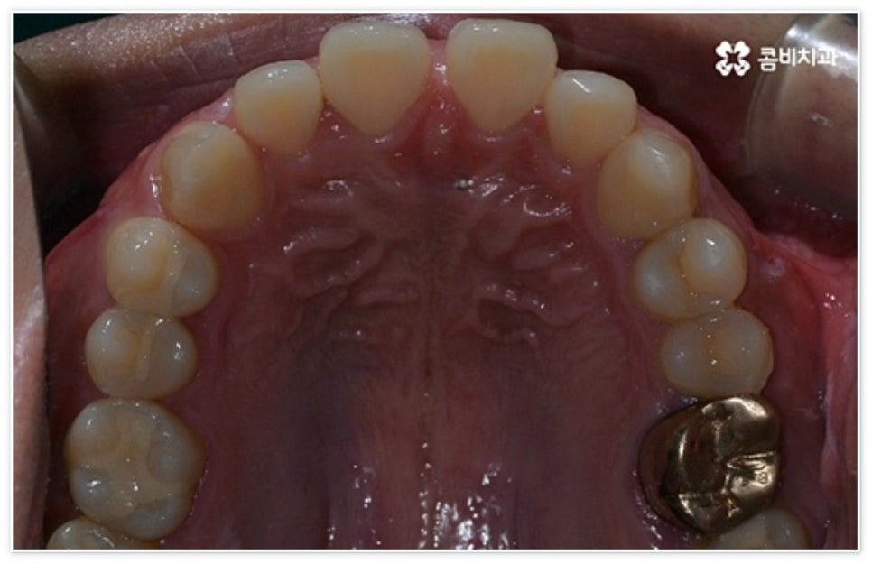 앞니 벌어짐 고치고 싶어요 관련 이미지 4